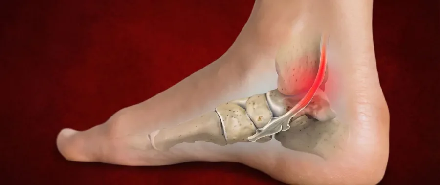Tibialis posterior1 1500x630